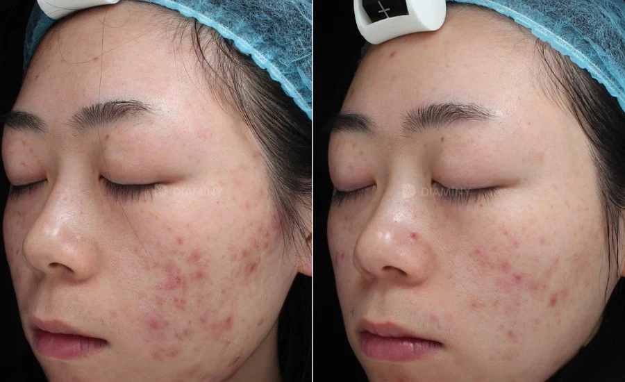 Le microneedling est-il efficace contre les cicatrices d'acn ? DiaminyAesthetics Le microneedling est-il efficace contre les cicatrices d'acn ? DiaminyAesthetics