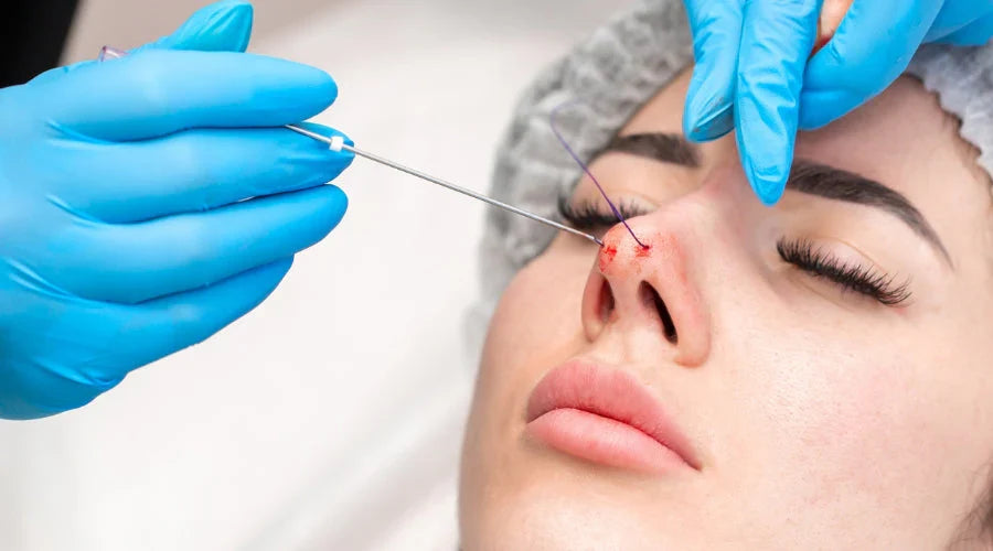 Dos and Don’ts After a Nose Thread Lift – DiaminyAesthetics