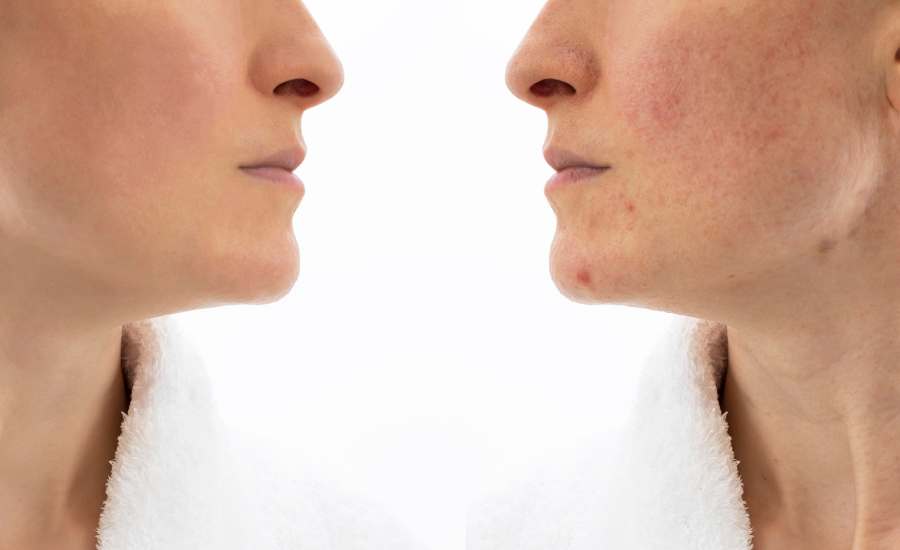 What is PDO Face Threading for Acne Scars? – DiaminyAesthetics