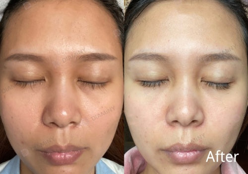 Microneedle Multi Needle Treatment | Skin Rejuvenation Experts ...